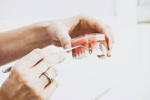 Dental Implants and Dentures